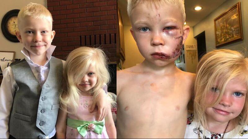 Menino de 6 anos leva mais de 90 pontos no rosto após salvar irmã de ataque de cachorro