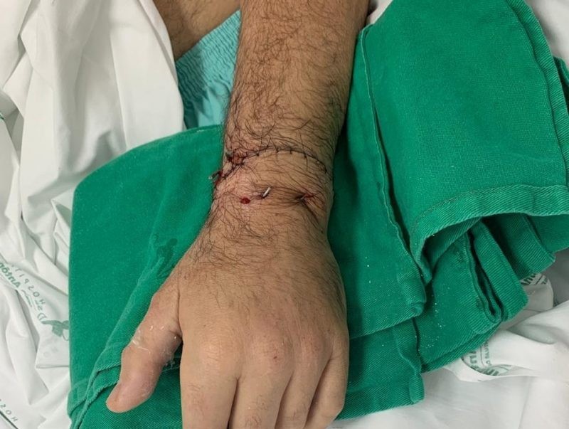 Homem tem mão reimplantada após perder membro em briga