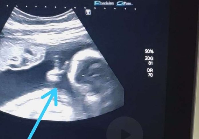 Bebê faz “V de vitória” durante o ultrassom e dá forças para o pai com câncer