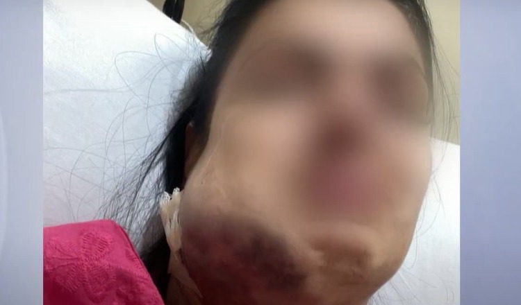 Mulher recebe alta após ser internada na UTI por lipo de papada mal sucedida em SC